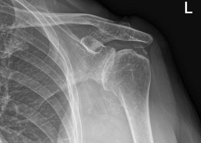 Shoulder Osteoarthritis | Vail, Denver CO