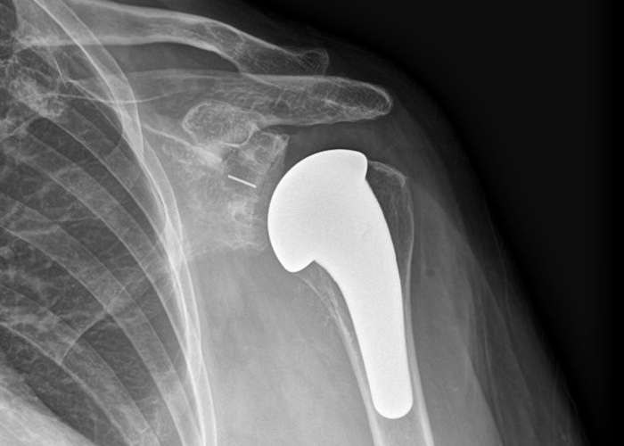 Total Shoulder Replacement | Colorado